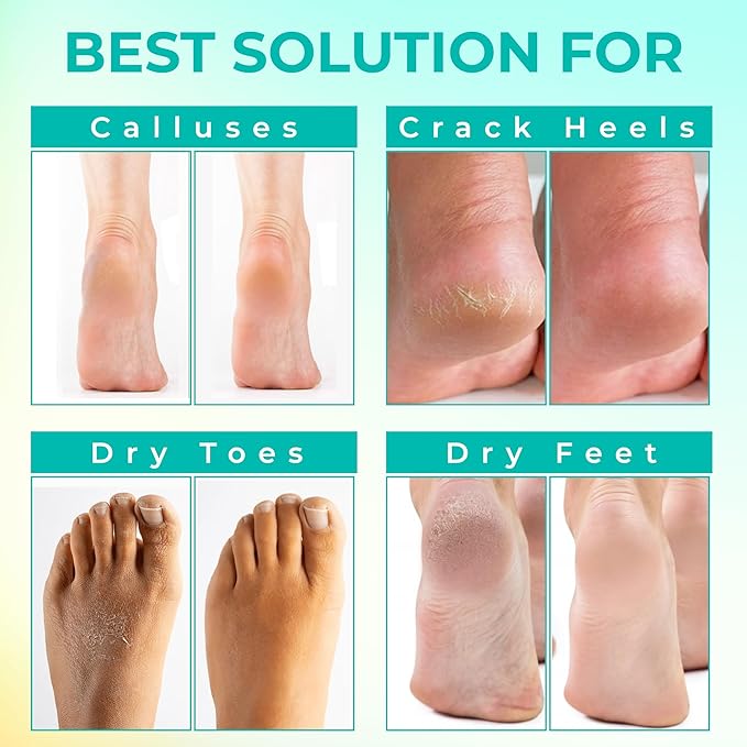 Happy Feet Foot Peel Mask, 03 Packs Original Exfoliant Foot Peel Mask, Callus Remover for Rough Cracked Dry Feet Dead Skin, Gift for Mom Dad