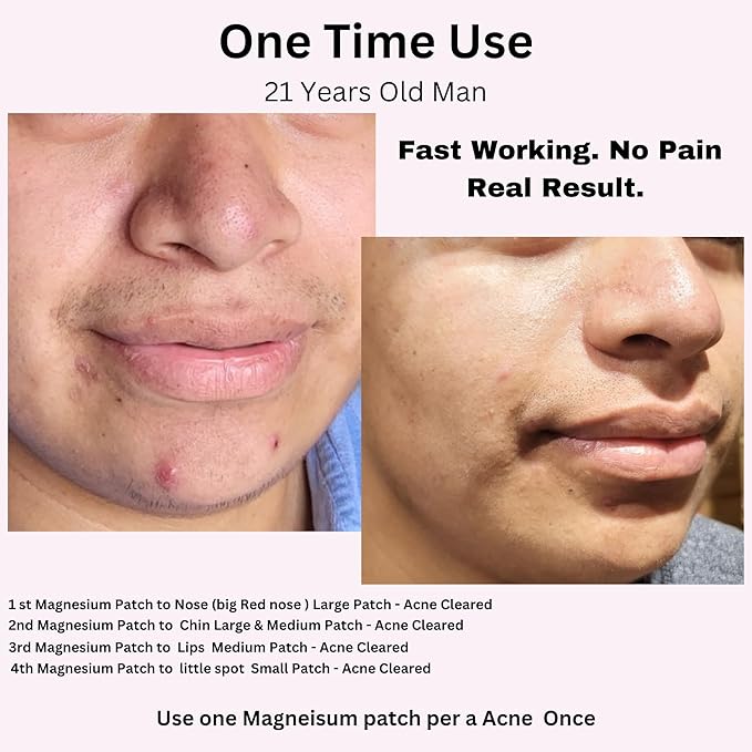 FreeGo Magnesium Acne Patches for Face. Blemish.Zit & Dark Spots from Post-Blemish, Acne .Zit. Self Dissolving,Hydrocolloid, Tee Tree oil & more (S 15pc)