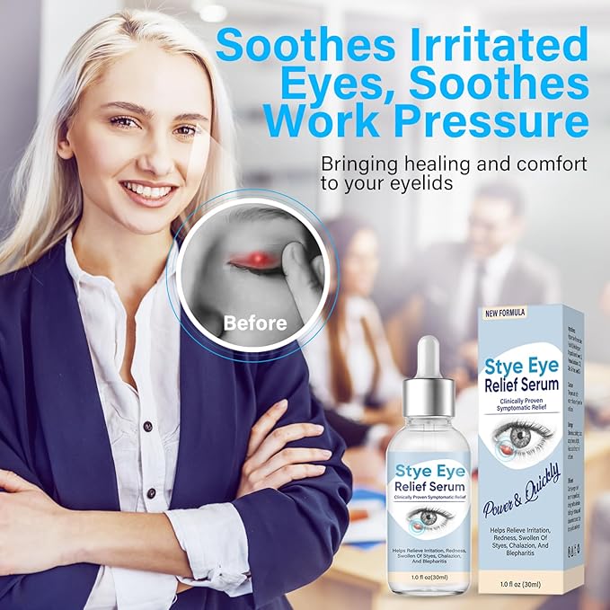 Stye Eye Treatment, Natural Stye Treatment Serum for Styes Chalazion and Blepharitis, Mild & Fast Relief