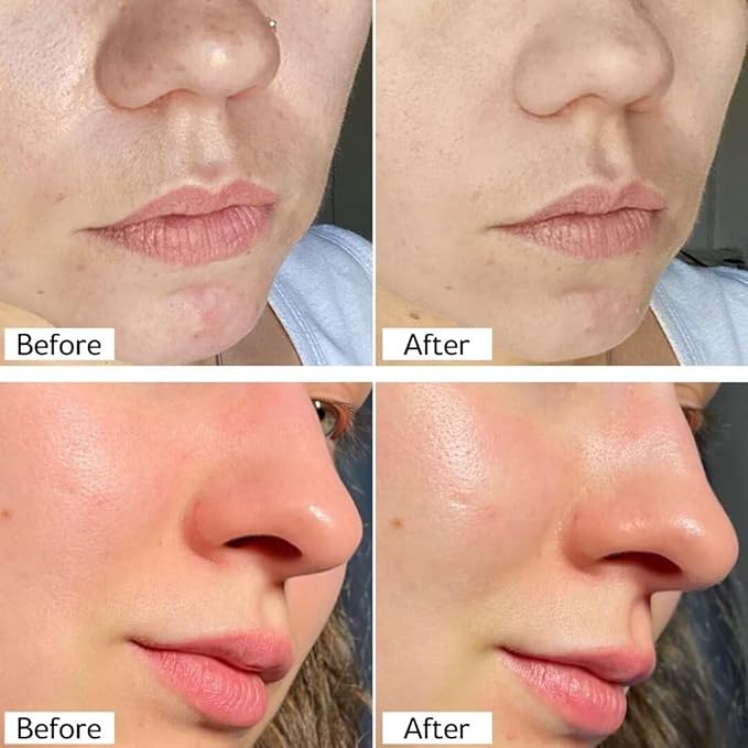 Deep Pore Clearing Mask with Salicylic Acid Face Cleanser Set, Removes Excess Oil, Reducer for Blackhead, Whitehead, Acne and Pores for Oily & Sensitive Skin Care for Women Men