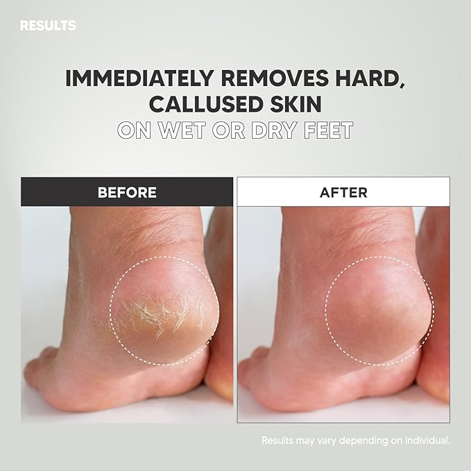 Wide Emery, Double-Sided Pedicure Tool, Colossal Foot File for Men & Women, Effective for Cracked Heel, Callus Remover, Foot Scrubber, Professional, (Gray)