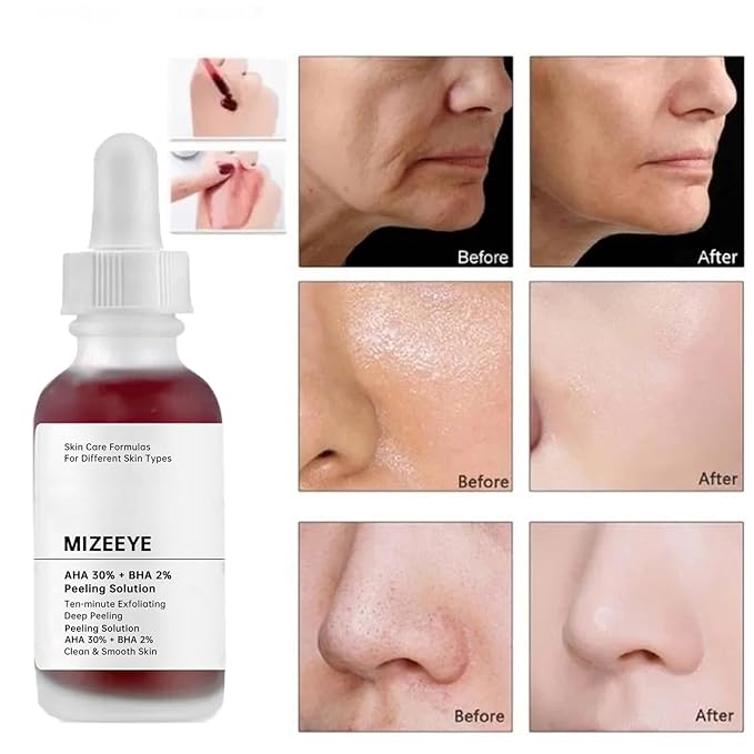 Peeling Solution 30ML, AHA 30% + BHA 2% Anti Acne Serum For Face, 2 PCS Exfoliating Facial Serum, Reduces Pore Congestion & Fine Line.
