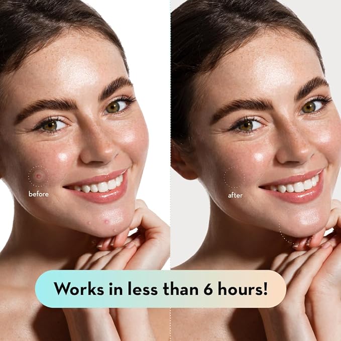 LE GUSHE K-BEAUTY Pimple Patches for Face (132 dots) & Under Eye Patches (30 Pairs). Gold Eye Mask with Collagen & Amino Acid, Cooling Eye Care for Wrinkles, Puffy Eyes & Dark Circles