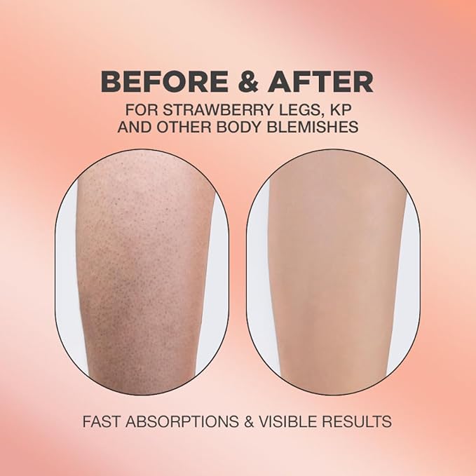 Strawberry Legs Treatment For Women Body Serum | Strawberry Legs Treatment For Women Exfoliating Body Serum | Chicken Skin Treatment Body Serum | Targets Strawberry Legs Treatment For Women