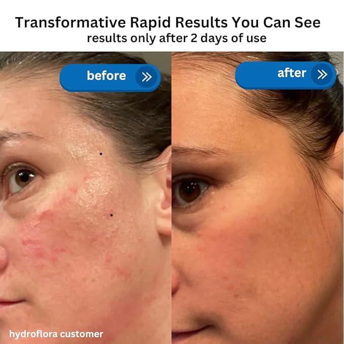 Hydroflora Barrier Repair Oil Gel – Lightweight Moisturizer for Dry, Sensitive Skin – Hydrating Face Oil with CoQ10 & Bakuchiol – Non-Comedogenic, Anti-Aging, Skin Barrier Support