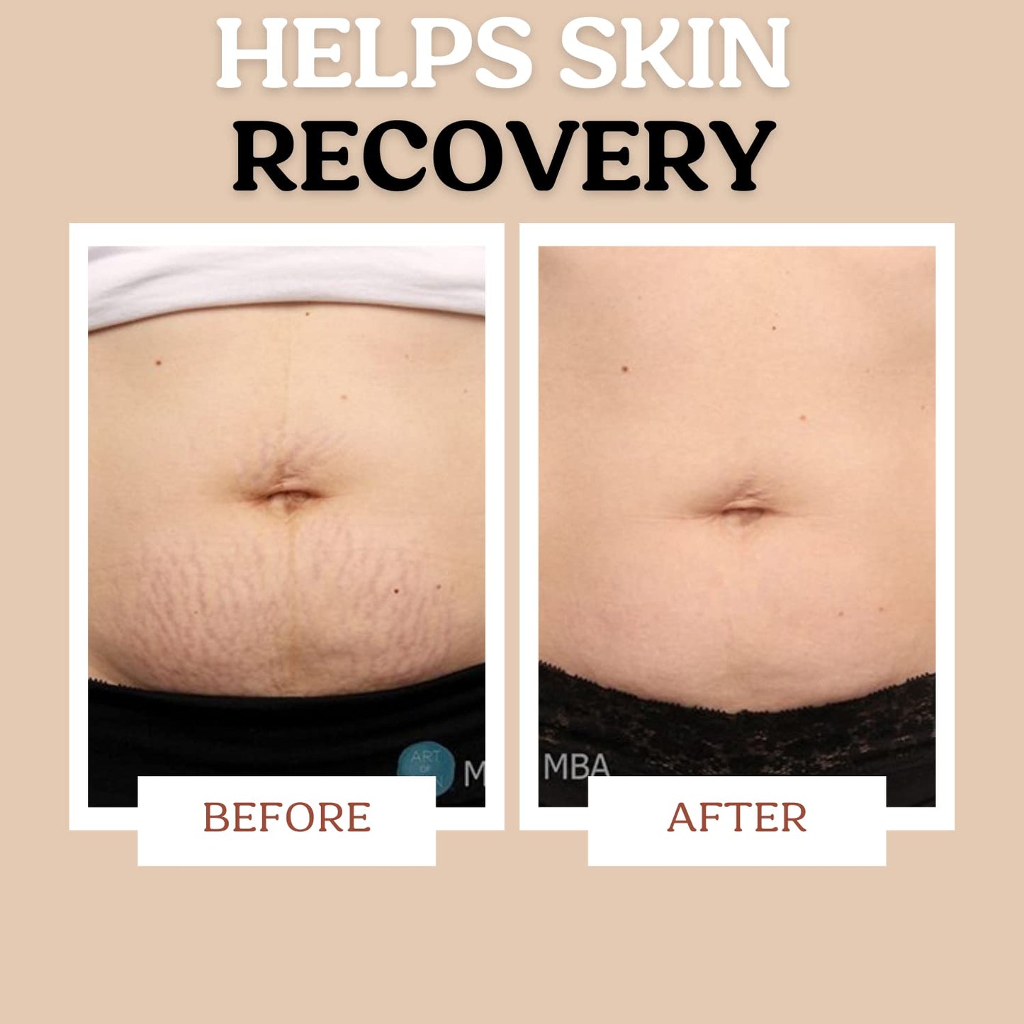 Stretch Mark Cream for Sensitive Skin Plant-Based Long and Short-term Hydration, Increases Skin Elasticity and Firmness (Stretch Mark Cream)