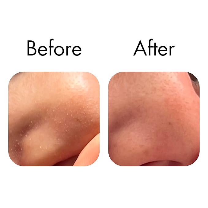 Fazit Nose Pore Patch