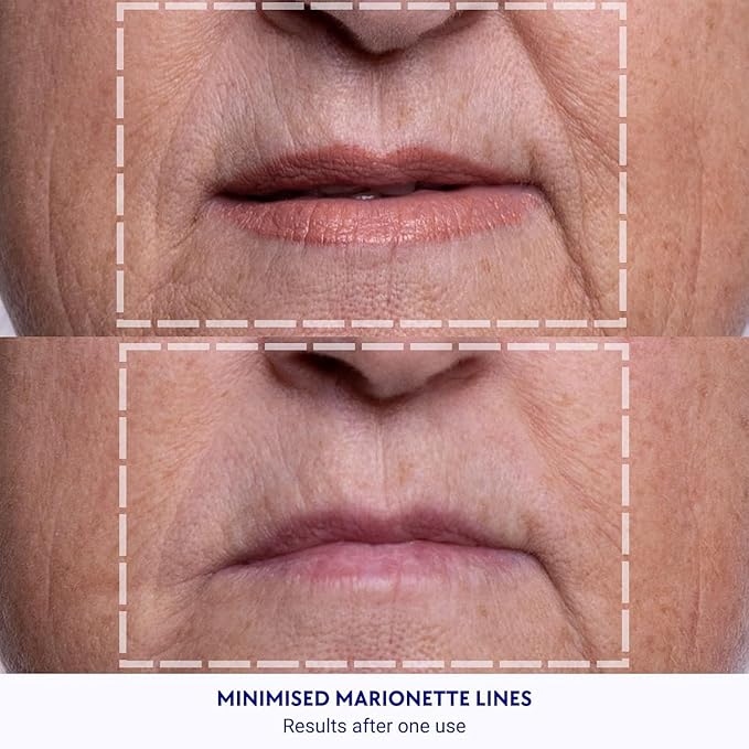 Wrinkles Schminkles Facial Smoothing Set | Mouth & Lip 2-Pack | Eye Wrinkle Patches 3-Pairs | Forehead Wrinkle Patches 2-Pack | Reusable Hypoallergenic Silicone Smoothing Pads