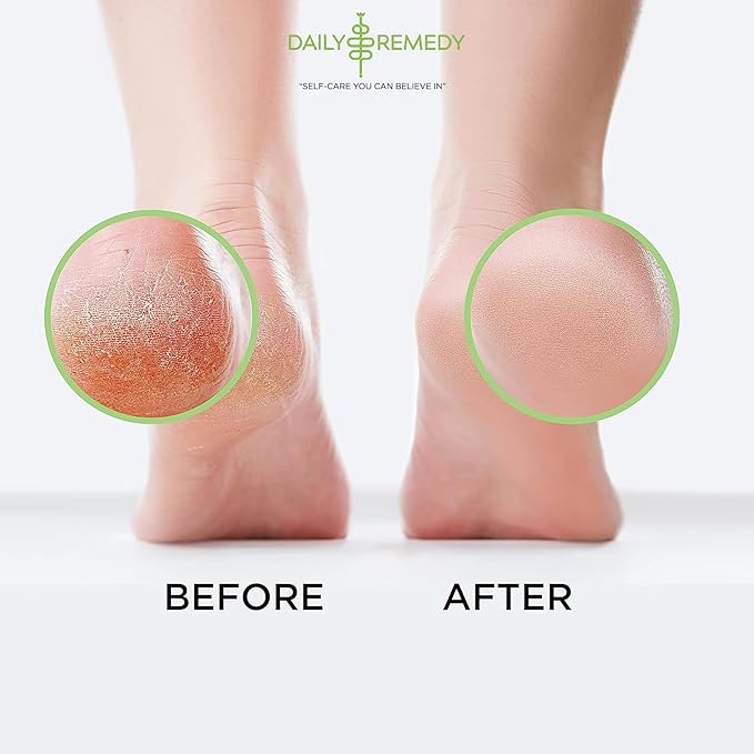 Tea Tree Oil Foot Soak with Epsom Salt - Made in USA - for Toenails, Athlete's Foot, itchy Feet, Stubborn Smelly Foot Odor, Pedicure, Foot Calluses & Soothes Sore Tired Achy Feet - 64 oz