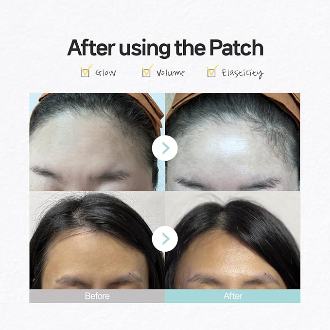 Hydrating & Anti-Wrinkle Patches for Forehead & Frown Lines – Korean Skincare with Collagen, Hyaluronic Acid & Vitamin E 8-Hour Overnight Face & Chest Lifting Mask (12 Count (Pack of 3))