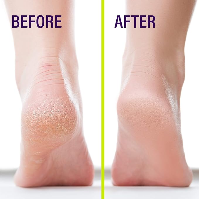 The #1 Liquid Skin Protectant for Cracked Heels, Cracked Feet Treatment, Liquid Bandage, Must-Have Foot Care for Cracked Feet, Calluses, Blisters, Foot Repair, Applicator and Buffer, 1Pk