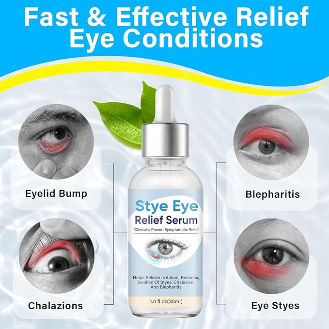 Stye Eye Treatment, Natural Stye Treatment Serum for Styes Chalazion and Blepharitis, Mild & Fast Relief