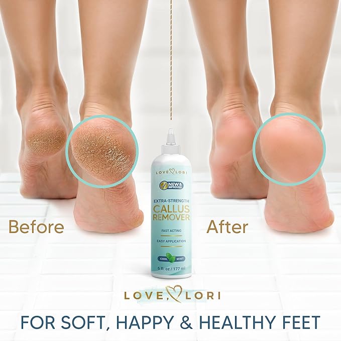 Callus Remover for Feet (Extra Strength) Professional Foot Scrubber Trimmer Dead Skin Callus Gel - Pedicure Tools for Feet Spa Essential, 6oz