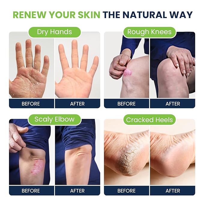 Tea Tree Foot Soak & Callus Remover Gel Kit - Extra Strength Callus Remover Gel & Foot Soak With Epsom Salts For Calluses & Tea Tree Oil Foot Cream - Moisturizing Athletes Foot Care For Dry Feet