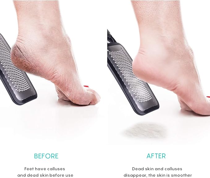 Foot Scrubber Pedicure Tools Rasp - 5 PCS KENED Foot File Callus Remover for Feet to Remove Hard Skin - 2 X Stainless Steel Black, 3 X Plastic Blue