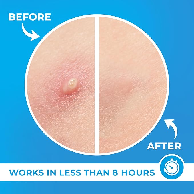 PatchRx Pimple Patches for Face (120 Patches), Hydrocolloid Acne Patches with Tea Tree Oil, Pimple Patch Pimple Stickers - Hydrocolloid Patch Acne Dots - Acne Pimple Patches For Face - Zit Patches