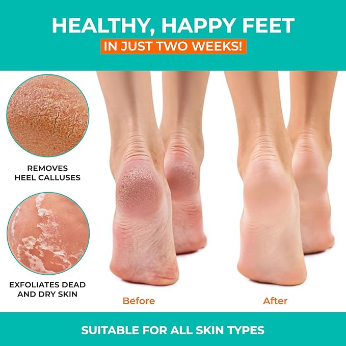 Happy Feet Foot Peel Mask Coconut, 03 Packs Original Exfoliant Foot Peel Mask, Callus Remover for Rough Cracked Dry Feet Dead Skin