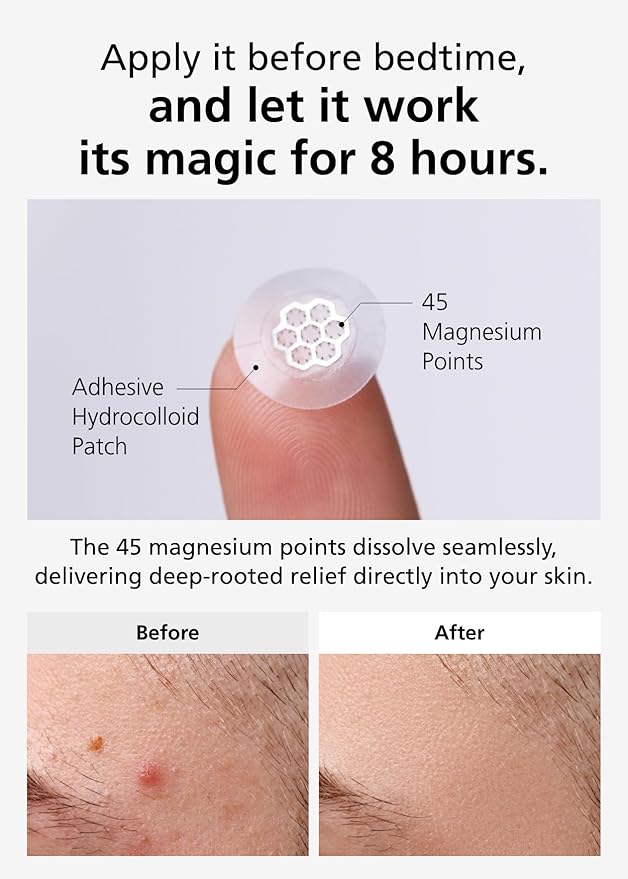 EasyDerm Quick Calming Magnesium Patches – Hydrocolloid Acne Spot Treatment Includes Tweezers & Ampoule, 10 Patches, Zit Sticker, TikTok Viral Blemish Patch, Made by Daewoong Pharmaceutical