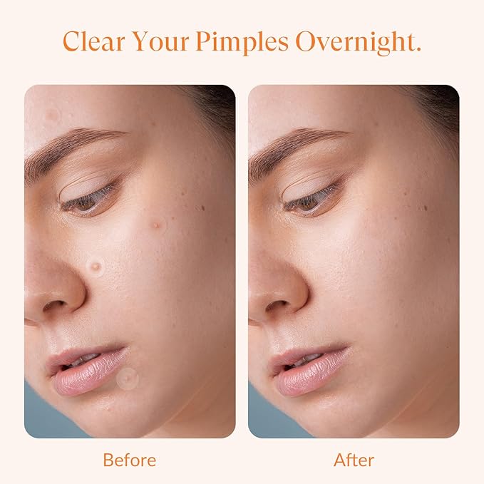 Hydrocolloid Pimple Patches with Salicylic Acid for Face, Acne Pimple Patch Invisible Spot Cover Treatment for Zits, Blemishes, and Pimples – Absorbing Zit Patch for Clear Skin (72 Count）