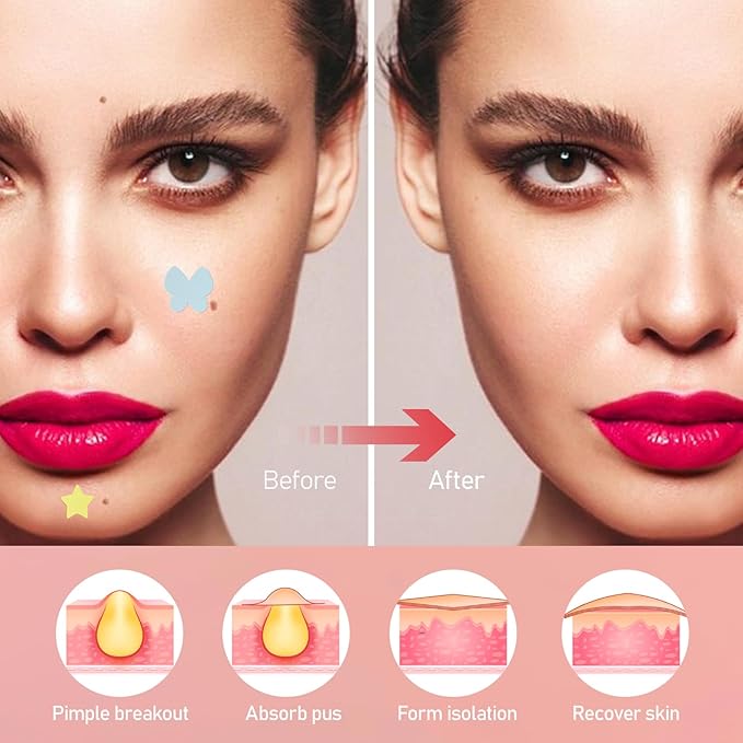 Pimple Patches for Face, 4 Shapes 200 Counts Acne Patches, Cute Star Hydrocolloid Patches Zit Patches, Blemish Patches with Salicylic Acid, Blemish Patches Tea Tree Oil