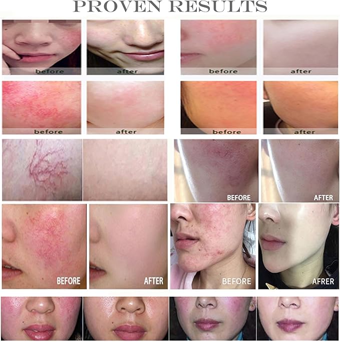 Keratinocyte Growth Factor Powder - KGF Freeze-Dried Powder Cosmetic Grade for Sensitized Skin, 1Milligrams, 900000IU, 96% Purity (2mg)