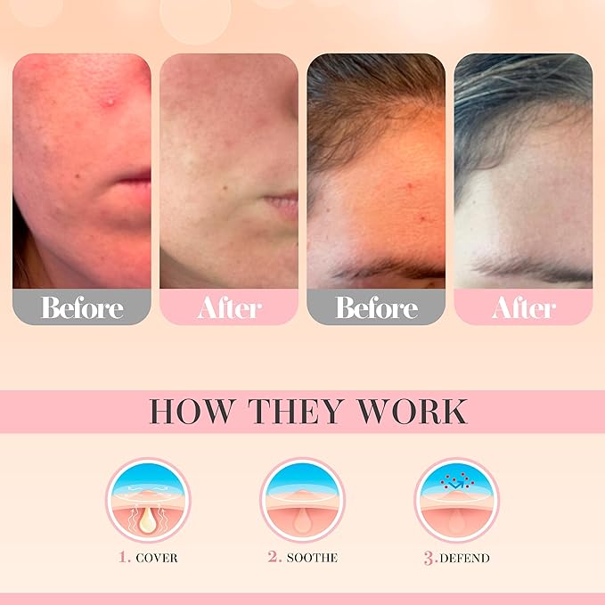 Glacia Pimple Patches 72 Pack of Hydrocolloid Skin Patches for All Skin Types – Gentle and Natural Patches for Clear and Smooth Skin