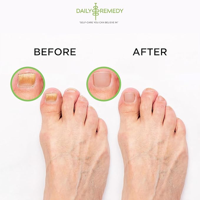 Tea Tree Oil Foot Soak with Epsom Salt - Made in USA - for Toenails, Athlete's Foot, itchy Feet, Stubborn Smelly Foot Odor, Pedicure, Foot Calluses & Soothes Sore Tired Achy Feet - 64 oz