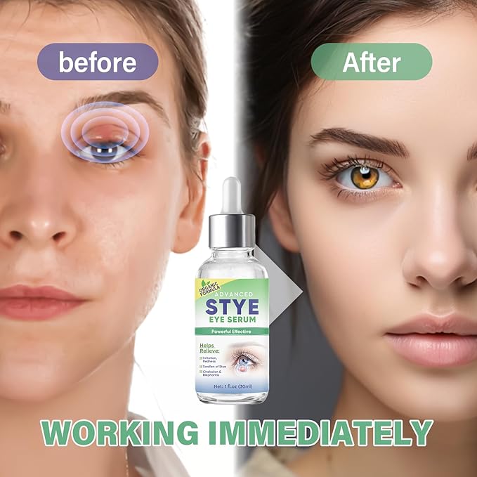 Stye Eye Treatment, Effective Stye Eye Drops Serum for Styes Chalazion and Blepharitis, Fast Chalazion Remover for Restore Healthier Ey-e Skin