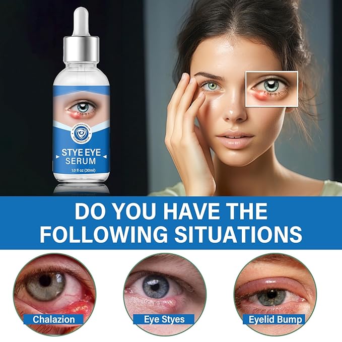 Stye Eye Treatment, Gently Cleanses Lashes and Eyes, Restore Healthier Eye Skin, 30 ml