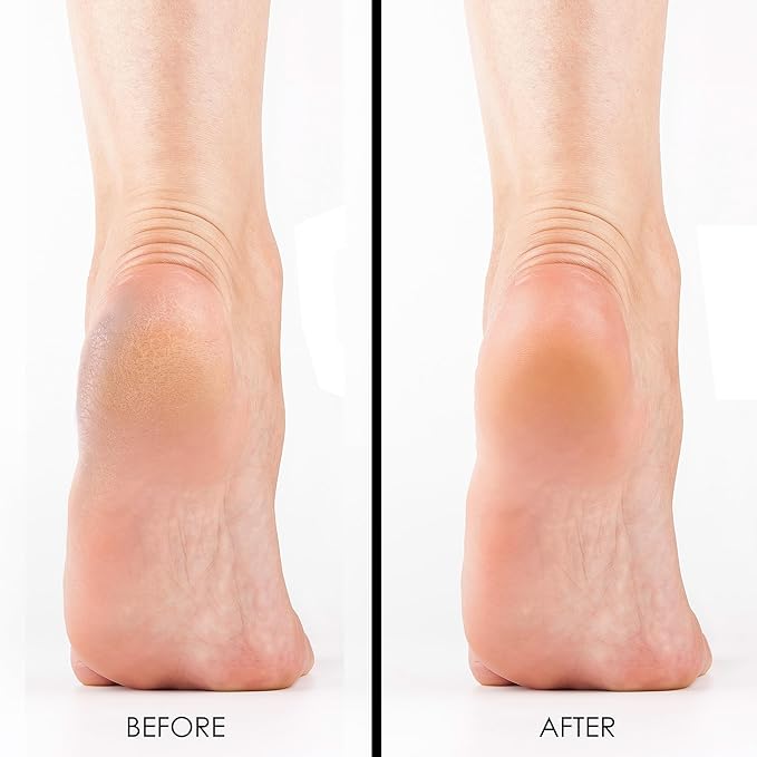 DeEnti Double Pumice Pack, Bundle Includes Mint Scented Callus Remover, 2 Pumice Stones for Feet, and 4 Pairs of Gloves, Salon Grade Foot Care, Home Manicure and Pedicure Kit