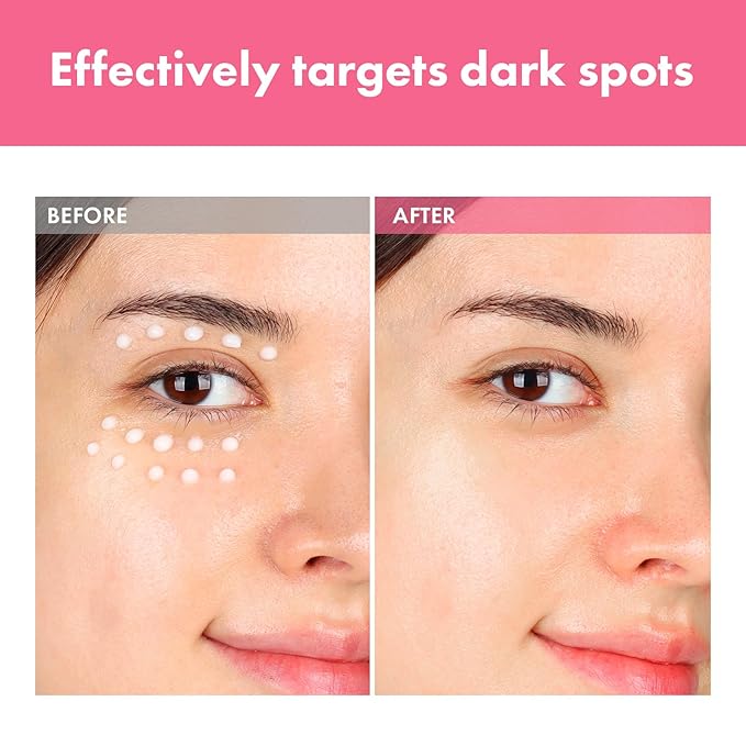 Arbutin 7% Intensive Spot Cream with 70,000ppm Arbutin, 3% Tranexamic Acid, 1% Niacinamide, Glutathione, Dark Spots, freckle, Blemishes, Anti-pigmentation, Korean Skin Care, 20ml, 0.67 fl.oz