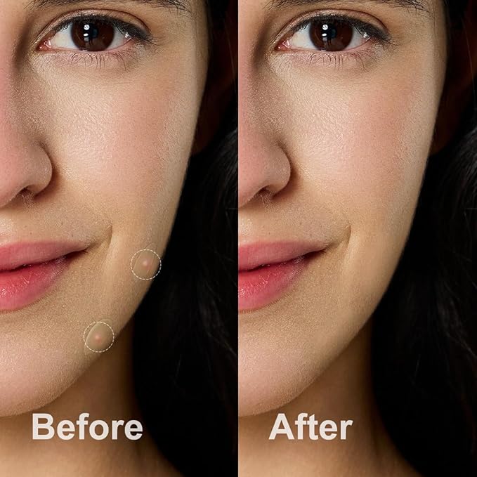 Pimple Patches for Face, Hydrocolloid Acne Patches, Absorb Zits and Blemishes, Invisible Spot Cover, Treatment for Breakouts, Acne Stickers with Salicylic Acid and Tea Tree Oil (36 Count)