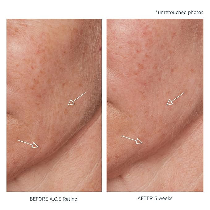 Santo Remedio, Piel Eterna, A.C.E. Retinol Intensive Rejuvenation Oil, Vitamin A, Vitamin C, Vitamin E, Squalane, Salicylic Acid, For Normal, Oily, or Combination Skin, 1 Fl. Oz.