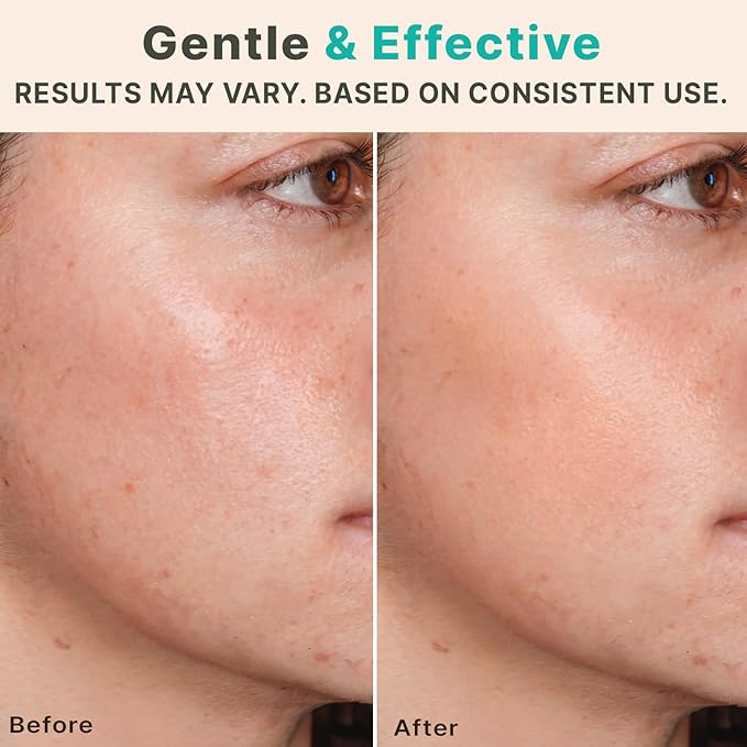 Derma Roller Microneedling Roller - Titanium 0.25mm Micro Needler for Face, Gently Exfoliates, Microneedle Tool for Beard, Scalp & Hair, Skincare Tools for Face