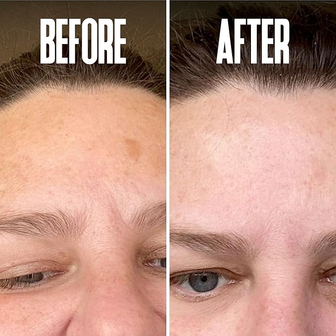 Save 18% on The Skin Care Solution For Dark Spots, Razor Bumps, Ingrown Hair & Razor Burns – Includes Our Ultra Potent Brightening + Razor Bumps Pads For an Ultra Clear & Glowing Skin