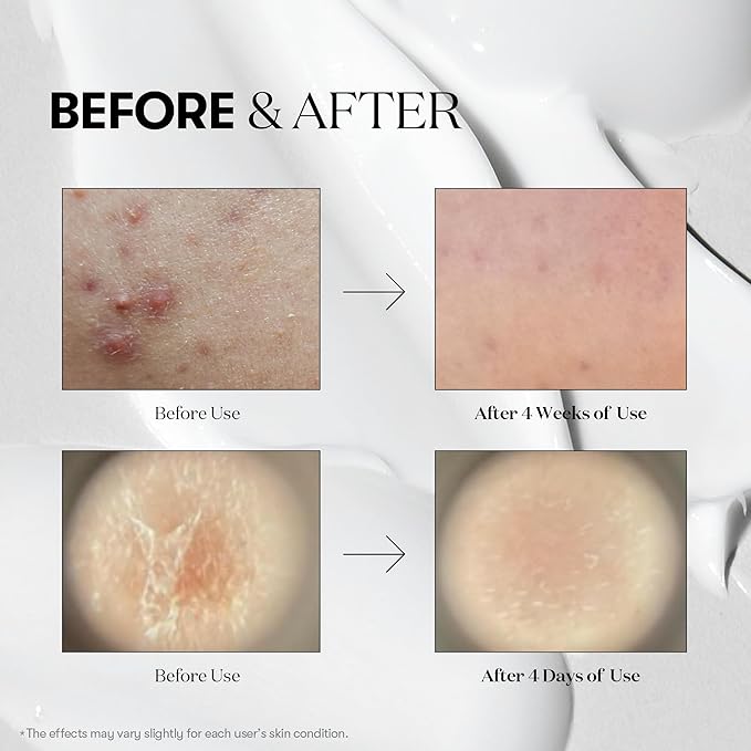 VT COSMETICS Reedle Shot 100 Duo Set with Collagen & Retinol Reedle Shot Pouch (Gift) – Exosome Microneedling Serum, Exfoliating, Soft & Glass Skin, Korean Skincare (1.69 fl. oz x2 / 0.06 fl. oz x6)