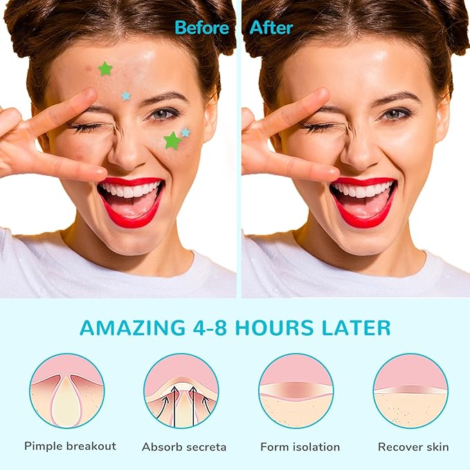 Star-Shaped Pimple Patch Hydrocolloid Acne Stickers with Tea Tree Oil + Salicylic Acid, Cover Dot for Acne Blemish, Pimples, Whiteheads, Zit, Draw out Oil & Impurities, 108 Dots, 12mm & 8mm