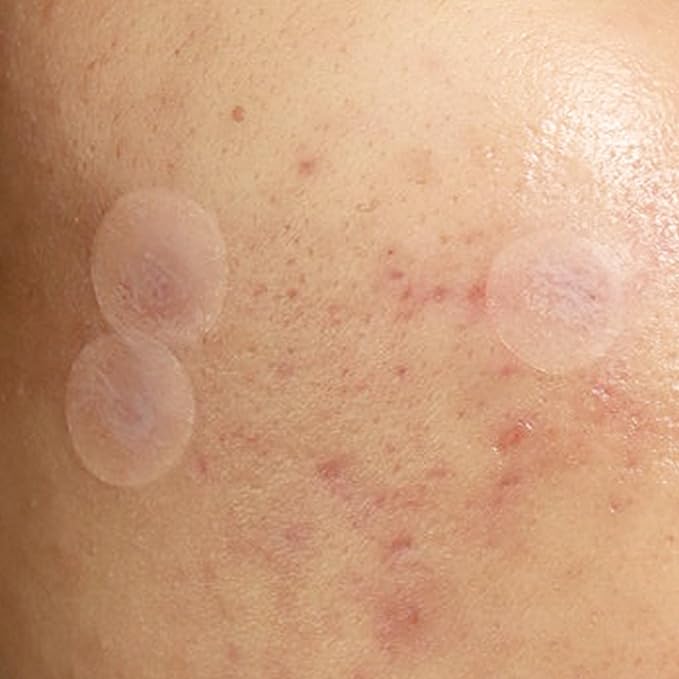 Julep Patch Me Up Waterproof Pimple Patches – 72 Hydrocolloid Acne Patches with Tea Tree Oil, Ultra-Thin Day & Potent Night, Reduces Blemishes & Scarring – 48 8mm & 24 12mm Patches