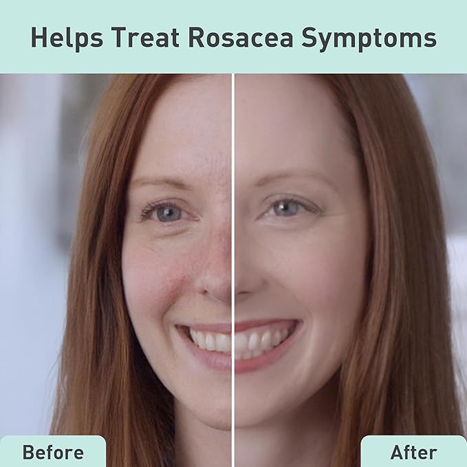 PROcure Rosacare Soothing Sheet Face Mask with Hyaluronic Hydrogel for Rosacea Symptoms, 5 Masks