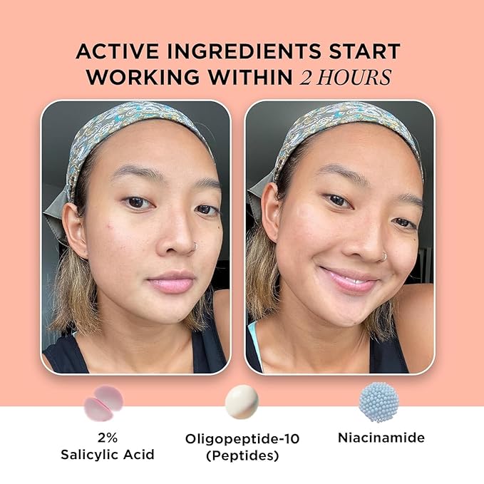 ZitSticka Extra Strength Killa Acne Patches for Face - World's Most Potent Pimple Patch with Fast-Acting Microdarts - Starts Working within 2 Hours for Deep, Early-Stage Zits & Blemish - 4 Count