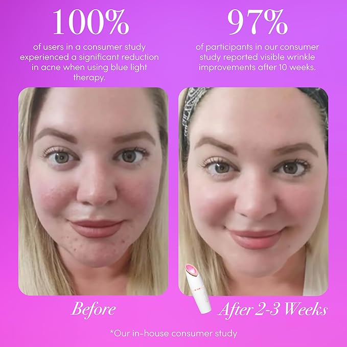 reVive Light Therapy Lux Collection Spot Acne Device for Face, Portable Red & Blue Light Therapy