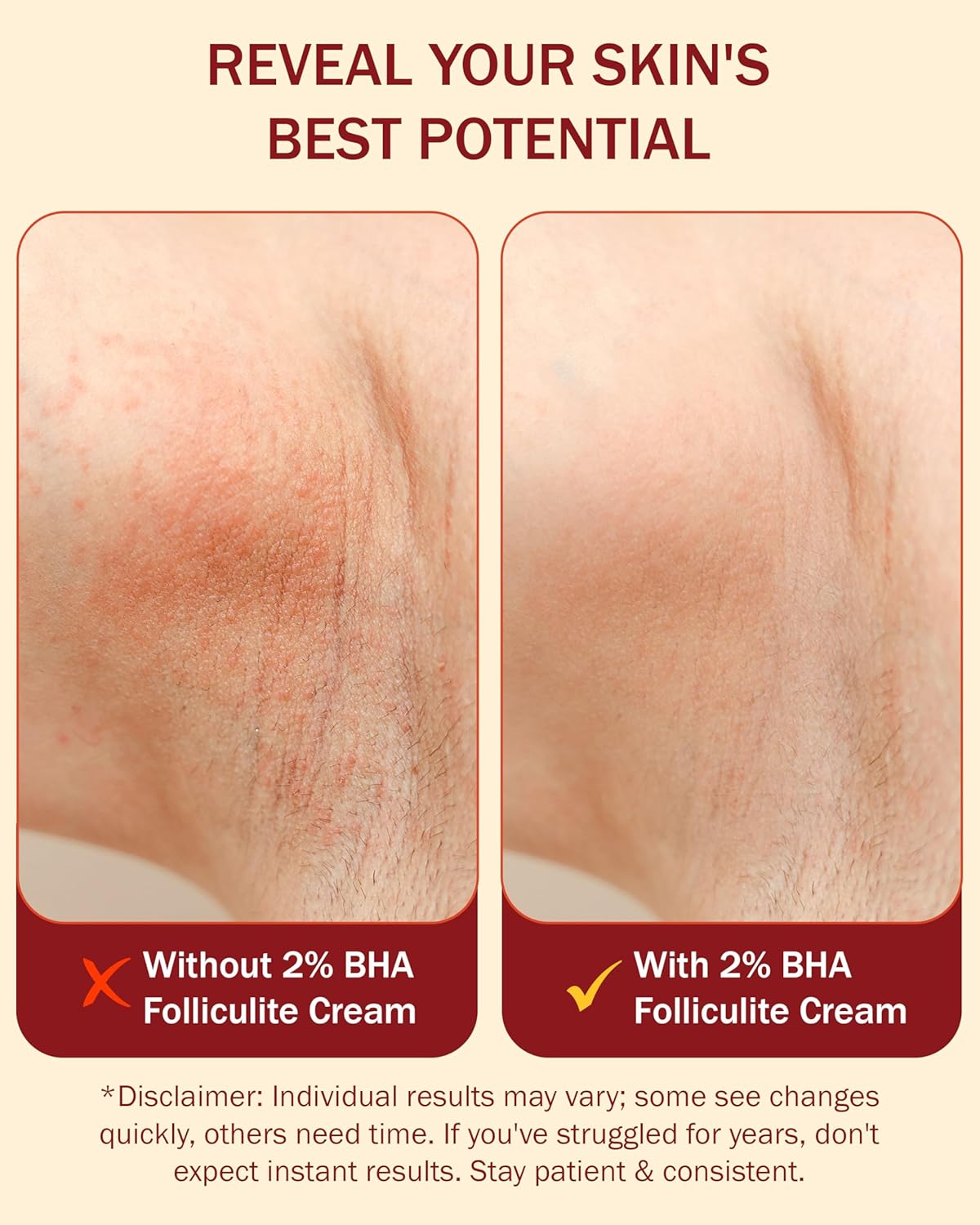 Folliculitis Cream – Folliculitis Treatment for Red Bumps, Ingrown Hairs & Razor Irritation – 2% BHA, Tea Tree, Salicylic Acid, Turmeric & Aloe – Scalp Acne treatment (4 oz)