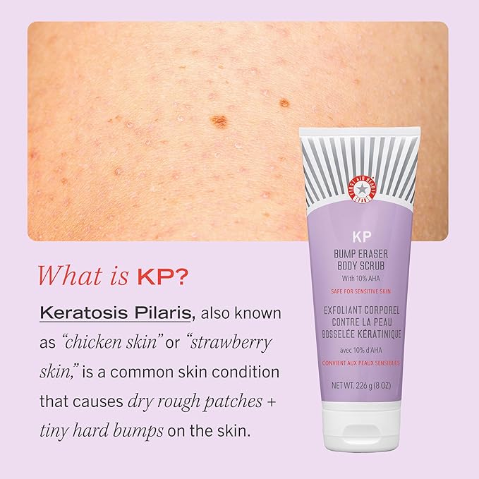First Aid Beauty - KP Bump Eraser Body Scrub with 10% AHA, Keratosis Pilaris Skin Exfoliater with Glycolic and Lactic acids, Helps Reduce Chicken Skin Bumps, Safe for Sensitive Skin, 10 oz