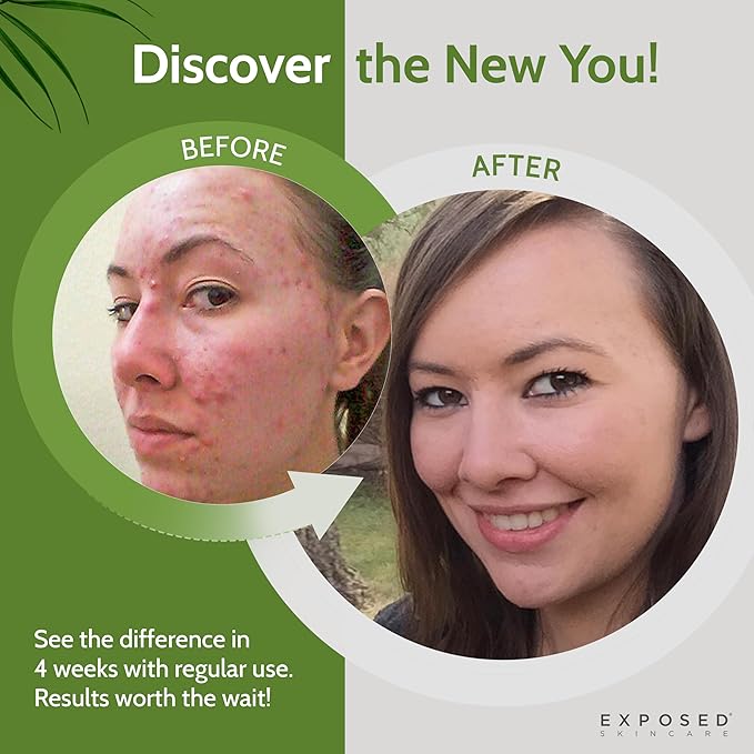 Exposed Skin Care Basic Acne Treatment Kit - Includes Salicylic Acid Face Wash, Clearing Tonic, Acne Treatment Serum with Benzoyl Peroxide, Clear Pore Serum - Acne Set Solution for All Skin Types