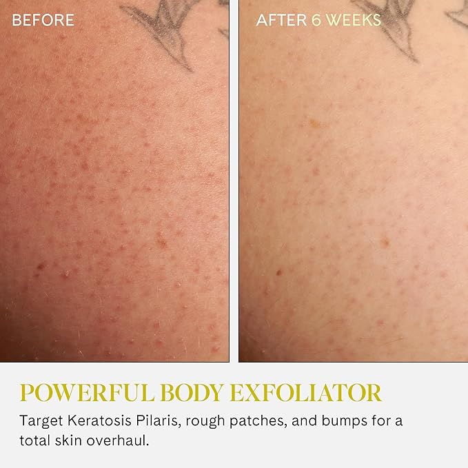 Fur KP Body Scrub - Powerful 14% AHA Body Scrub for Keratosis Pilaris or Rough Patches to Smooth and Clear Skin using Lactic Acid and Physical Exfoliants While Moisturizing the Skin - 6 oz