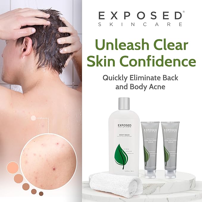 Exposed Skin Care Body Acne Kit – Dual Acne Treatment Serums + Body Wash and Exfoliating Body Cloth – Powerful System Eliminates Pimples and Breakouts to Quickly Clear Back and Body Acne