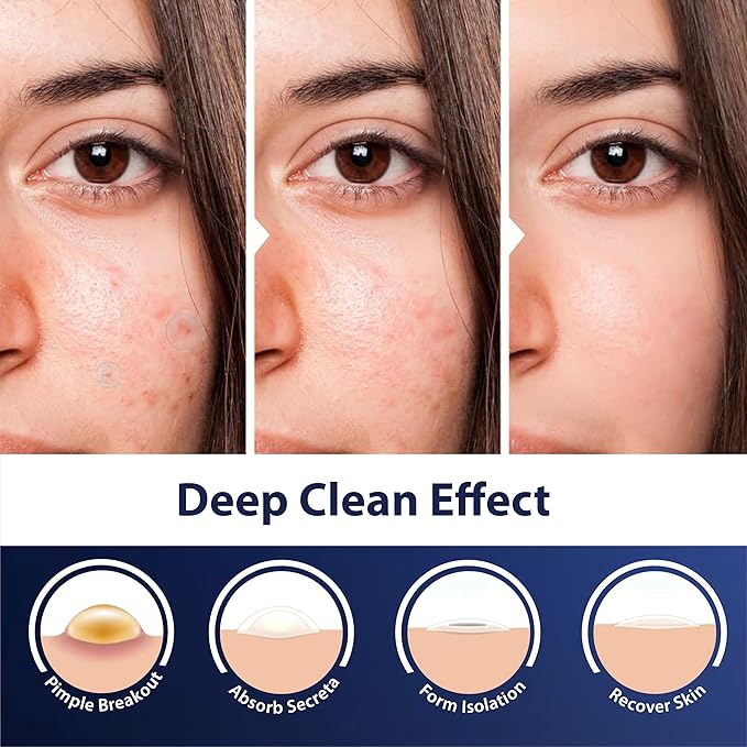 Dot Pimple Patches for Face – Hydrocolloid Acne Patches for Quick Zit Relief, Invisible Spot Stickers That Stay All Night, Gentle for All Skin Types, Oil-Free (240 Count)