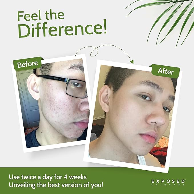 Exposed Skin Care Body Acne Kit – Dual Acne Treatment Serums + Body Wash and Exfoliating Body Cloth – Powerful System Eliminates Pimples and Breakouts to Quickly Clear Back and Body Acne