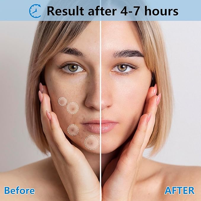 Pimple Patches for Face, 4 Size 360 Counts Acne Patches, Hydrocolloid Patches for Covering Zits and Blemishes, Spot Stickers with Salicylic Acid, Tea Tree Oil & Centella