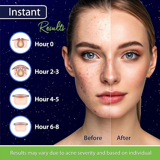 Star Pimple Patches for Face – Hydrocolloid Acne Patches for Quick Zit Relief and Blemishes, Invisible Spot Stickers That Stay All Night, Gentle for All Skin Types, Oil-Free (240 Count)